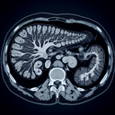 МРТ підшлункової залози